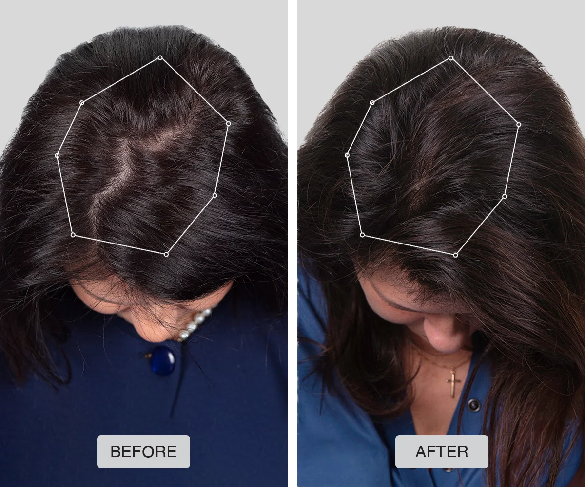 Casco láser crecimiento del cabello 272