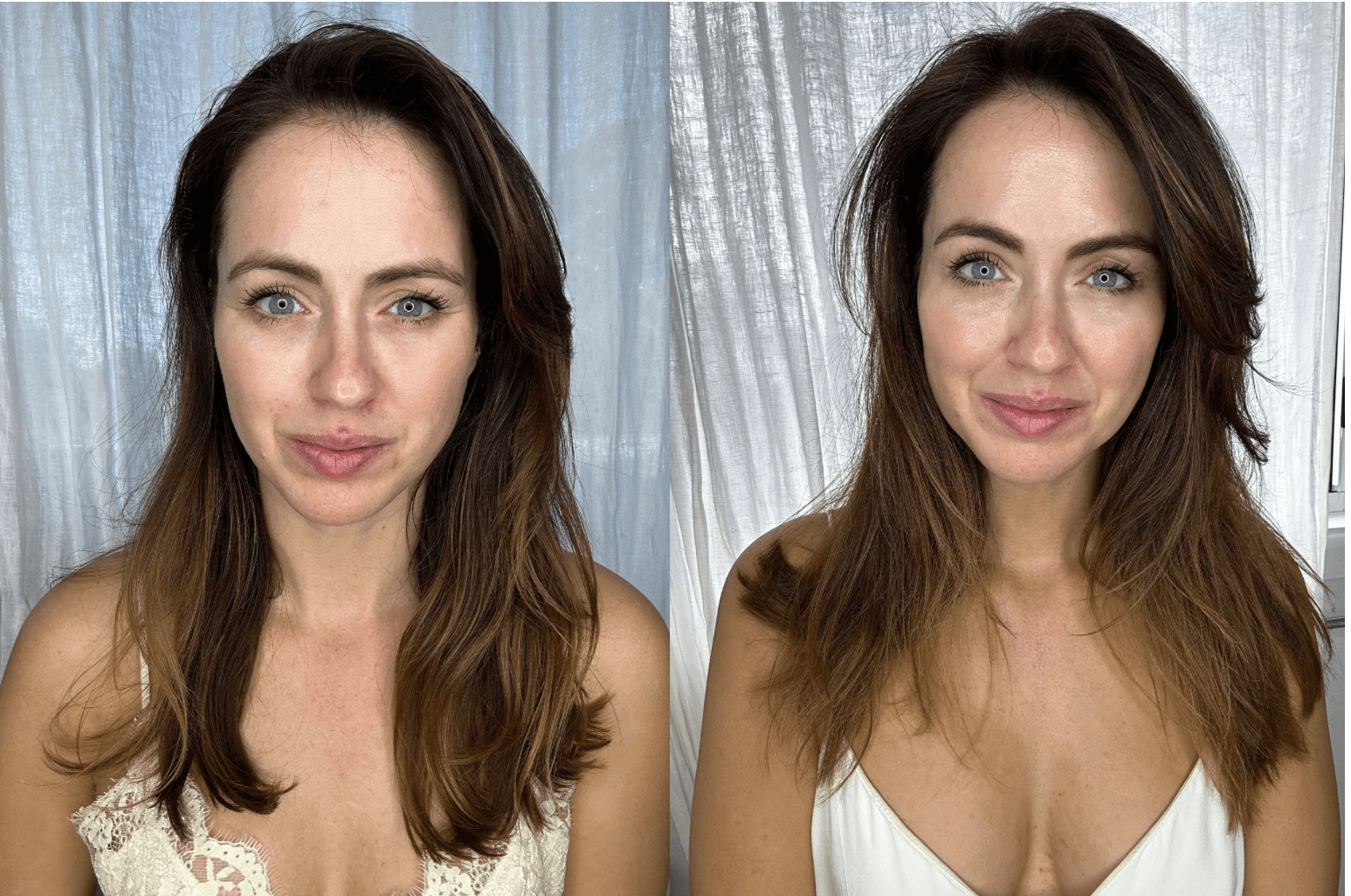 Tresiore microneedle infusion