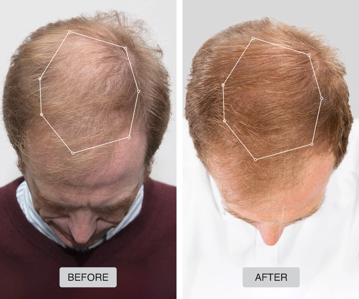 Casco láser crecimiento del cabello 272