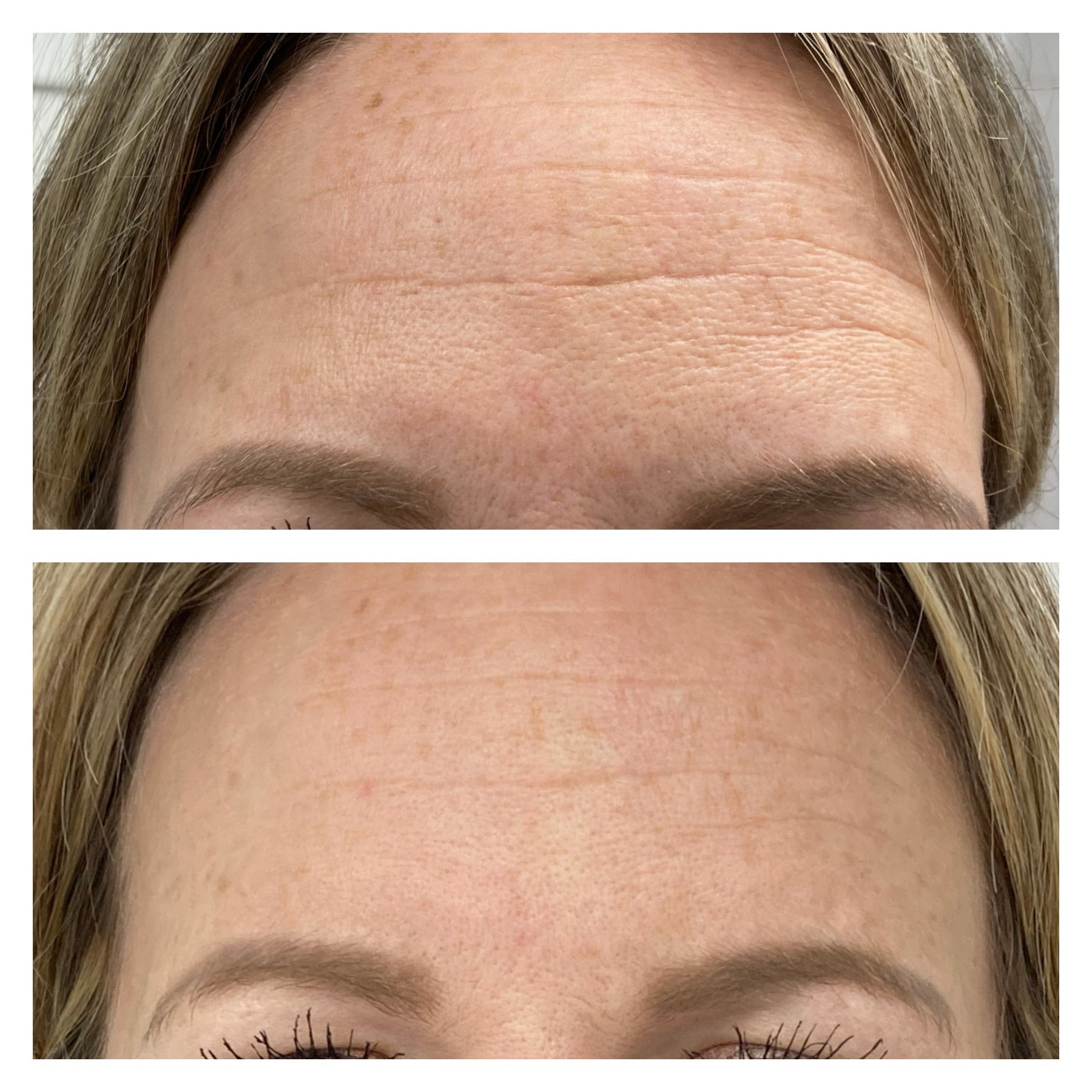 Tresiore microneedle infusion