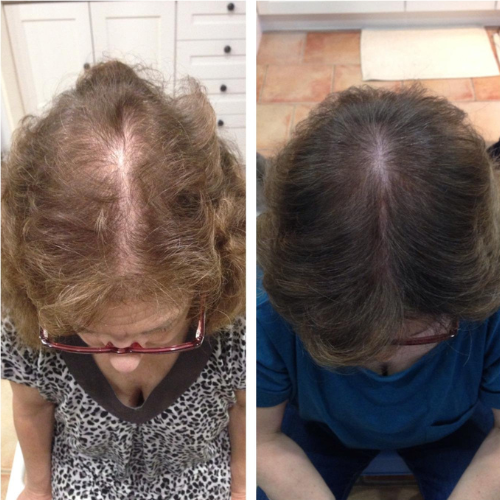 Capacete laser para crescimento capilar