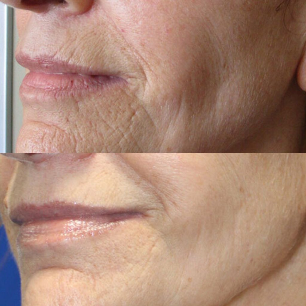 Tresiore microneedle infusion
