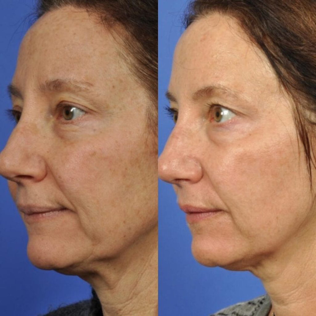 Tresiore microneedle infusion